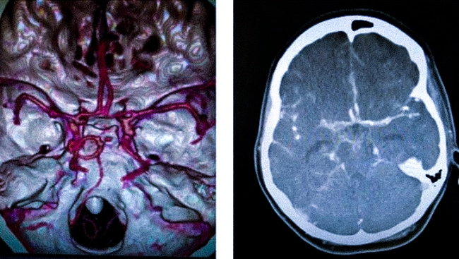 Субарахноидальное кровоизлияние на снимках МСКТ ангиографии и компьютерной томографии головного мозга