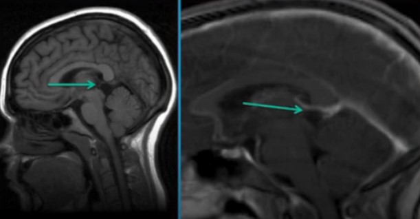 До- и постконтрастное изображение головного мозга на МРТ