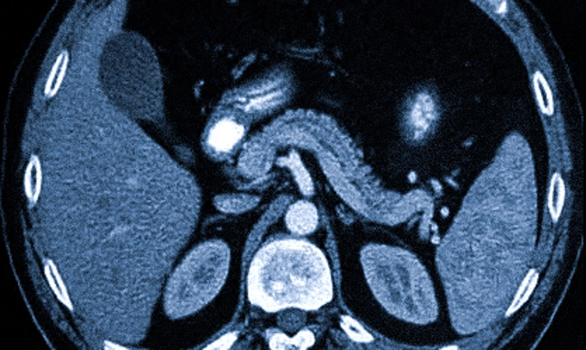 Норма поджелудочной железы на КТ