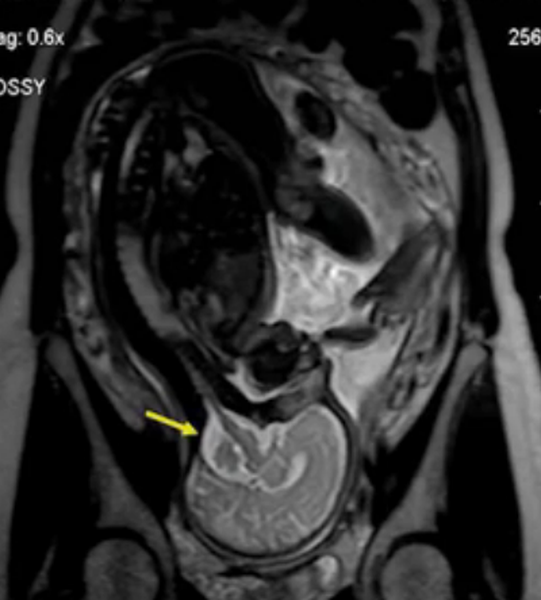 МР-сканирование беременной