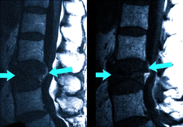 Опухоль позвоночника на МРТ