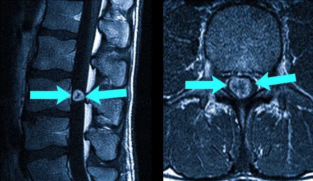 Опухоль позвоночника на МРТ