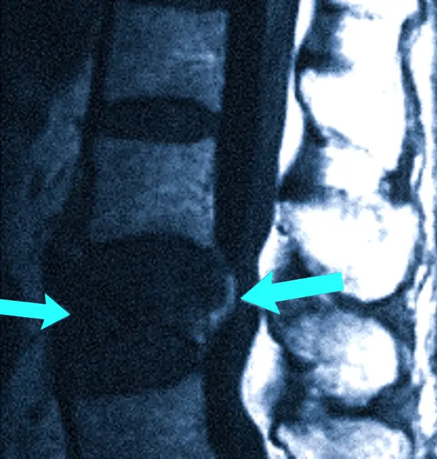Опухоль позвоночника на МРТ