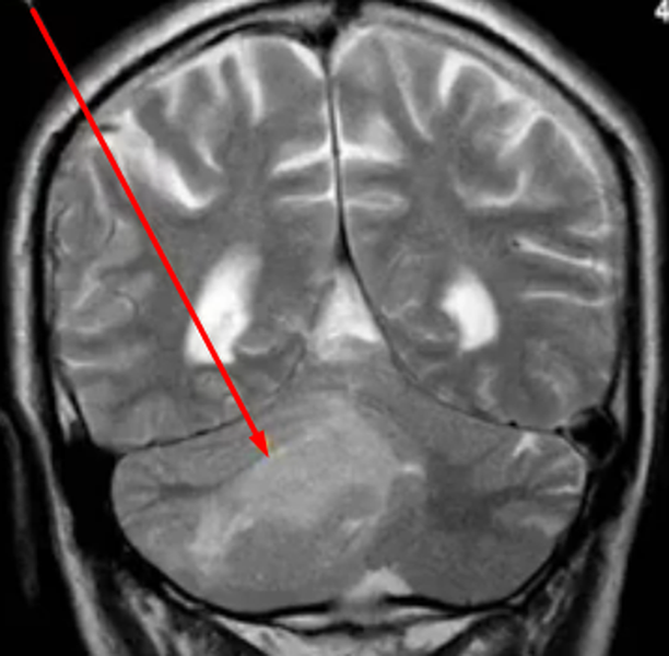 Опухоль мозжечка на МРТ 