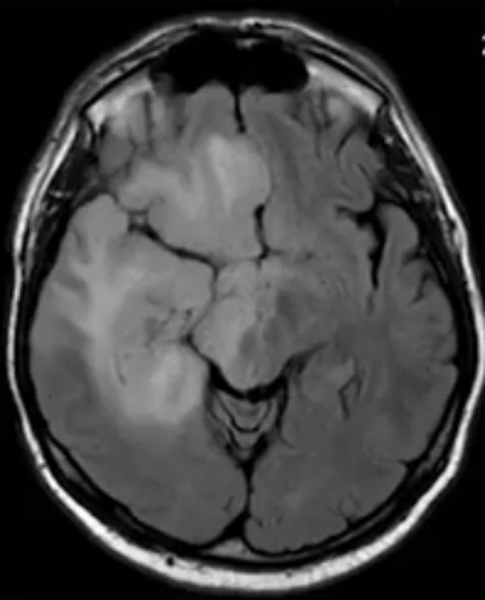Глиобластома на МРТ головного мозга