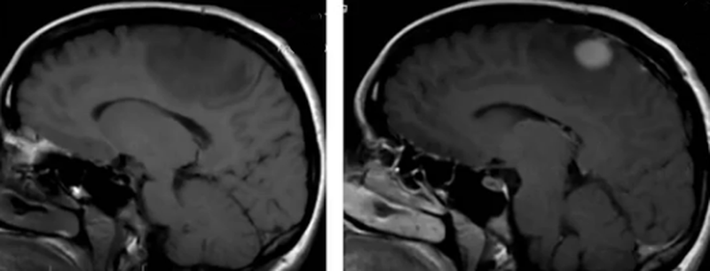 До- и постконтрастное изображение злокачественной опухоли головного мозга