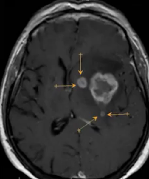 Опухоль головного мозга на МРТ с отсевами