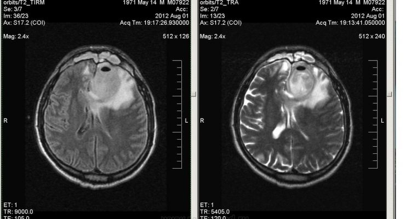 Вазогенный отек из-за абсцесса на МРТ