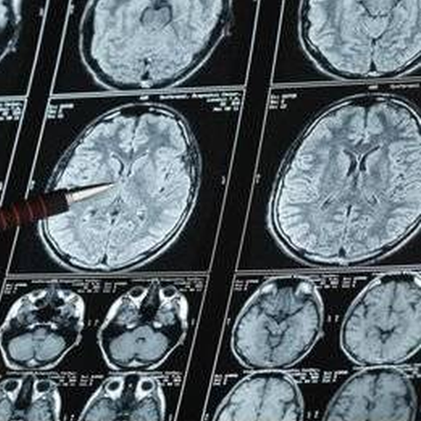 Отек головного мозга на МРТ