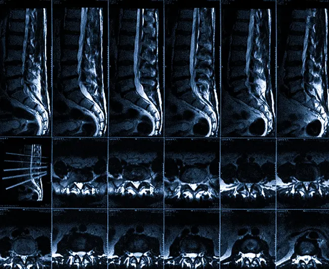 МР-диагностика заболеваний позвоночника