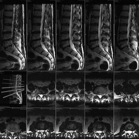 Отек костного мозга на МРТ позвоночника