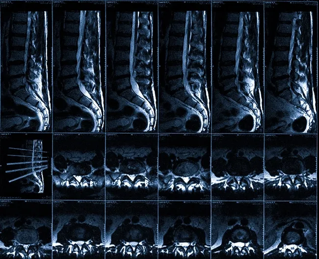 МРТ позвоночника
