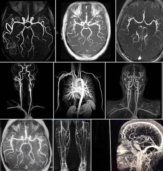 МРТ-ангиография сосудов головного мозга