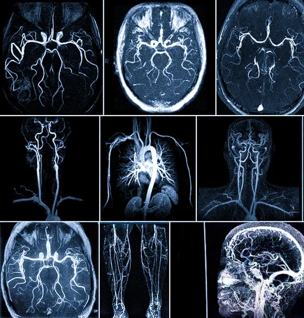 МРТ-ангиография сосудов головного мозга