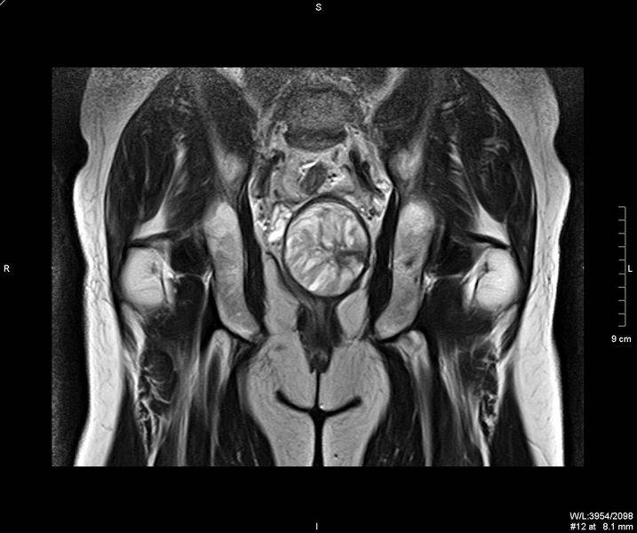 Снимок МРТ органов малого таза женщины