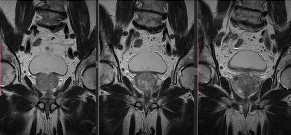 Магнитно-резонансная томография простаты, фото во фронтальной проекции
