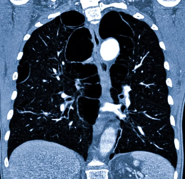 Буллезная эмфизема легких на КТ