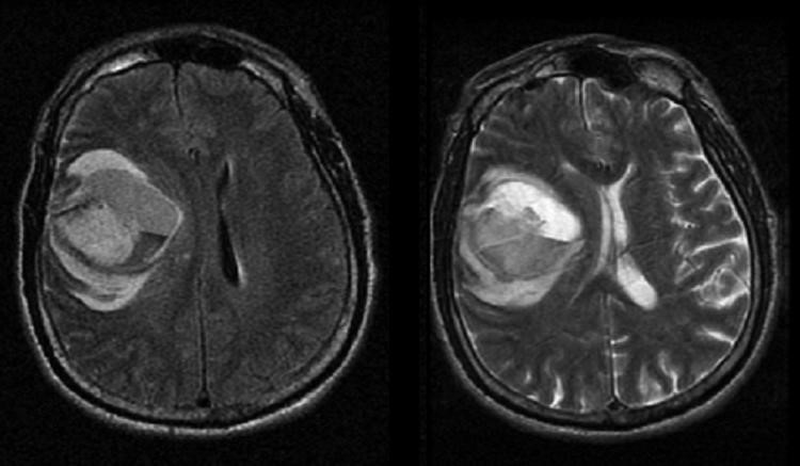 МРТ головного мозга после кровоизлияния в опухоль