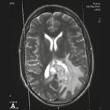 Показания к МРТ головного мозга