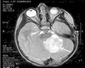 МРТ мозга: белой стрелкой указана опухоль мозжечка больших размеров