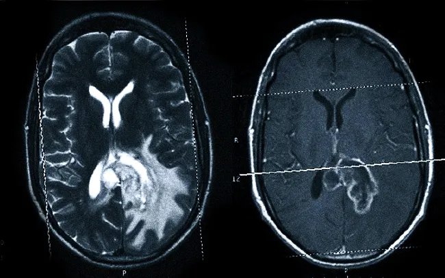 Злокачественная внутримозговая опухоль: А - Т2-взвешенное изображение, показывающее образование в левых теменной и затылочной долях; В - постконтрастное Т1-взвешенное изображение, усиление визуализации