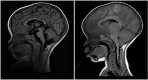 МРТ головного мозга детям проводят для уточнения причины судорог или задержки развития