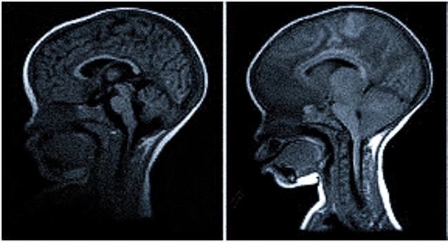 МРТ головного мозга детям проводят для уточнения причины судорог или задержки развития