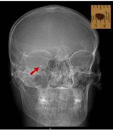 Рентгенография черепа: инородное металлическое тело в проекции правого глаза (красная стрелка) - недопустимое условие для проведения МРТ головы
