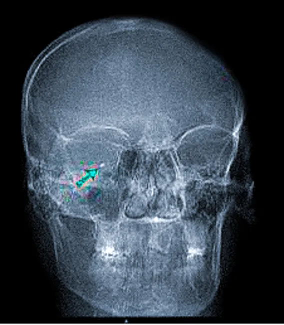 Рентгенография черепа: инородное металлическое тело в проекции правого глаза (красная стрелка) - недопустимое условие для проведения МРТ головы