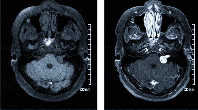 МРТ головного мозга нативная и с усилением: шваннома левого внутреннего слухового нерва становится ярче после введения гадолиния