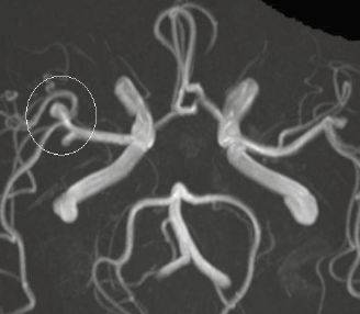 Магнитно-резонансная ангиография сосудов головы: церебральная аневризма в правой средней мозговой артерии (указана окружностью)