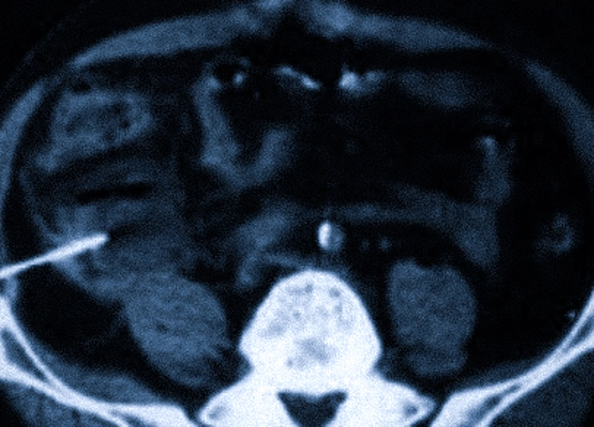 Абсцесс аппендикса в процессе дренирования под контролем компьютерной томографии