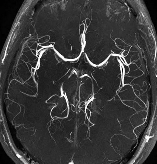Снимок артерий головного мозга