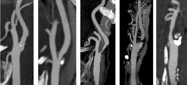 Стеноз и окклюзия артерии на снимках МРТ