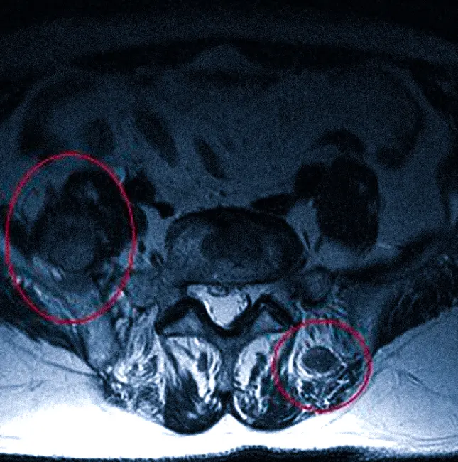 Метастазы на МРТ позвоночника