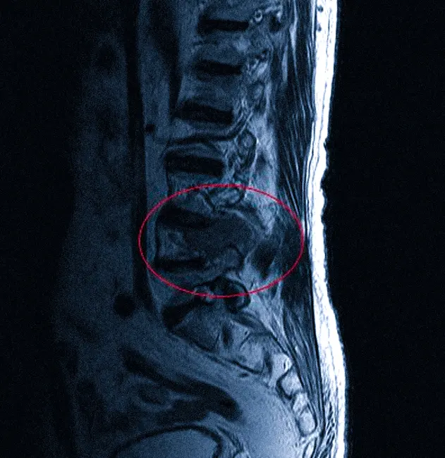Опухолевое образование в пояснично-крестцовом отделе позвоночника на МРТ