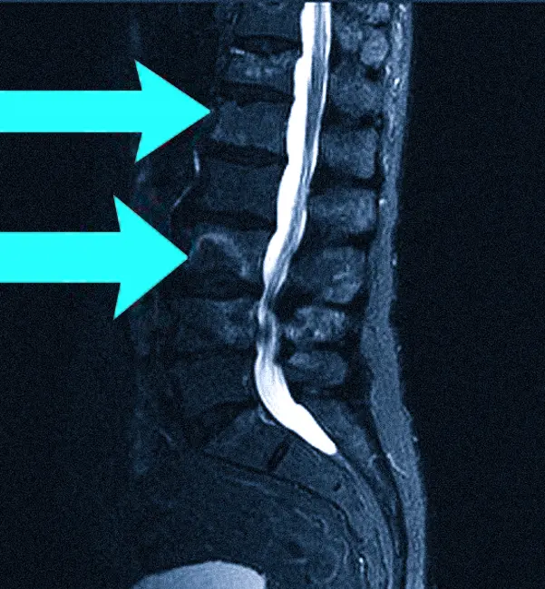 Метастазы в позвоночнике на МРТ