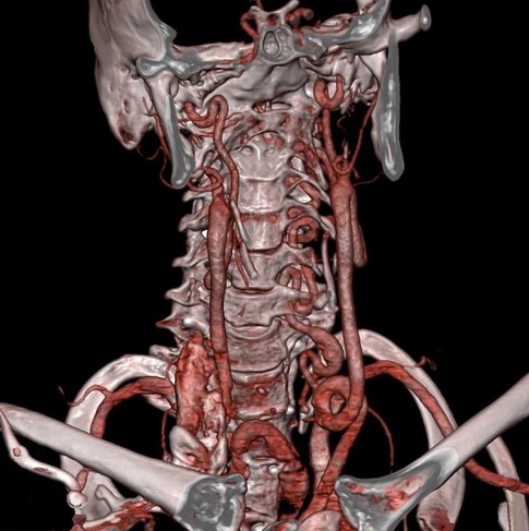 3D-модель позвоночных артерий, полученная при КТ-ангиографии