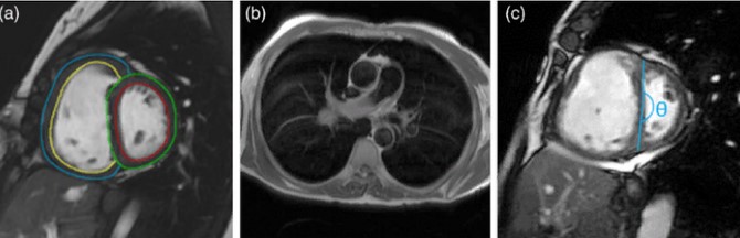  Примеры изображений: (а) - масса желудочков, (б) - визуализация расширенных легочных артерий 