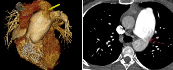 Компьютерное сканирование с мультипланарной реконструкцией: незаращение Боталлова протока с забросом контраста из расширенной легочной артерии в аорту