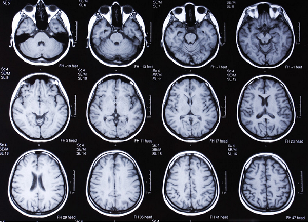 МРТ головы, серия послойных изображений