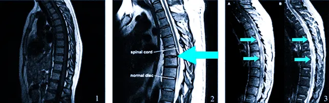 Здоровый позвоночник и позвоночник с протрузией