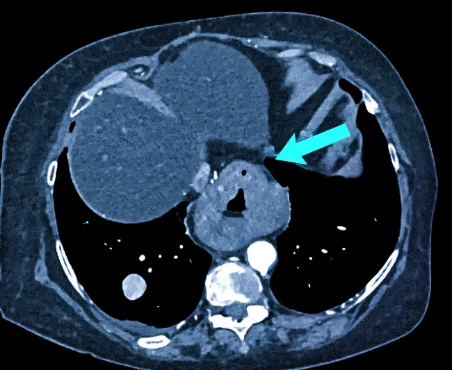 КТ-снимок рака нижний части пищевода