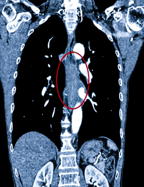 Рак среднегрудного отдела пищевода на КТ