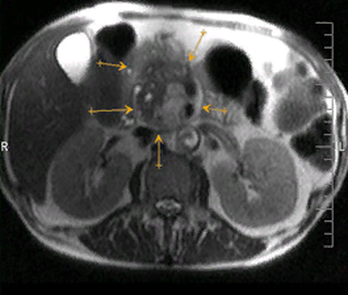 Рак поджелудочной железы на МРТ