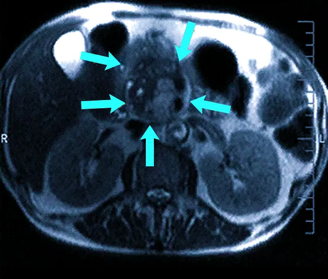 Рак поджелудочной железы на МРТ