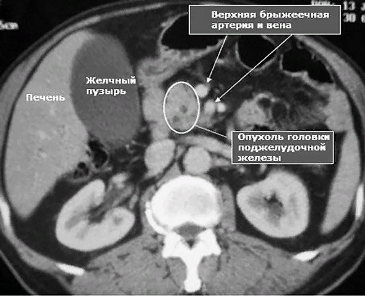 Органы и сосуды на МРТ брюшной полости