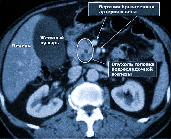 Органы и сосуды на МРТ брюшной полости