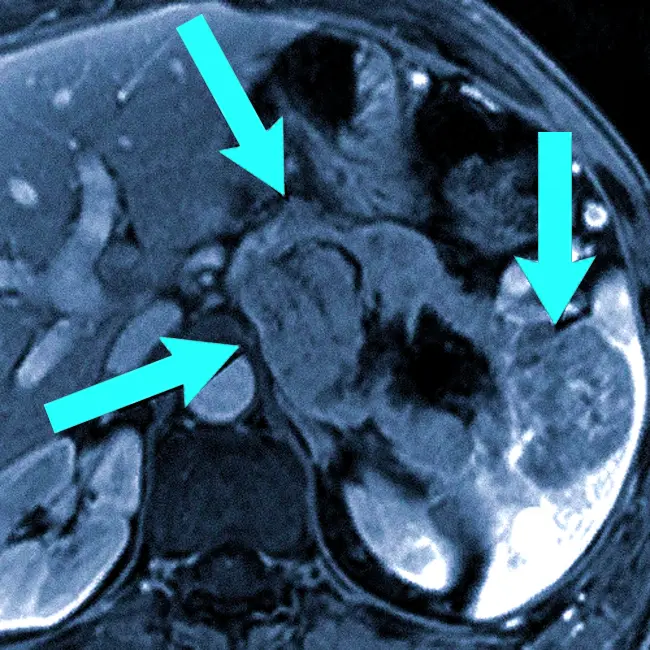 Рак поджелудочной железы на МРТ