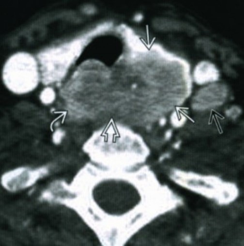  КТ с контрастированием: прорастание рака щитовидной железы в трахепищеводную борозду, лимфаденопатия (отмечены стрелками)